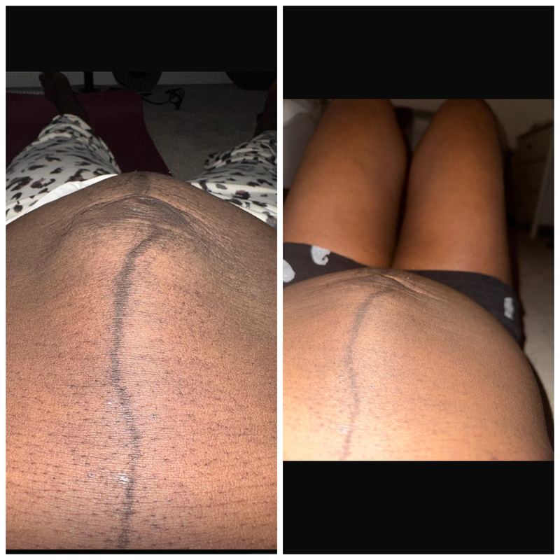 C-section recovery progress – belly healing after caesarean birth